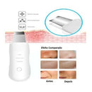 Skin Lifting E Peeling Ultrassônico Limpeza Pele